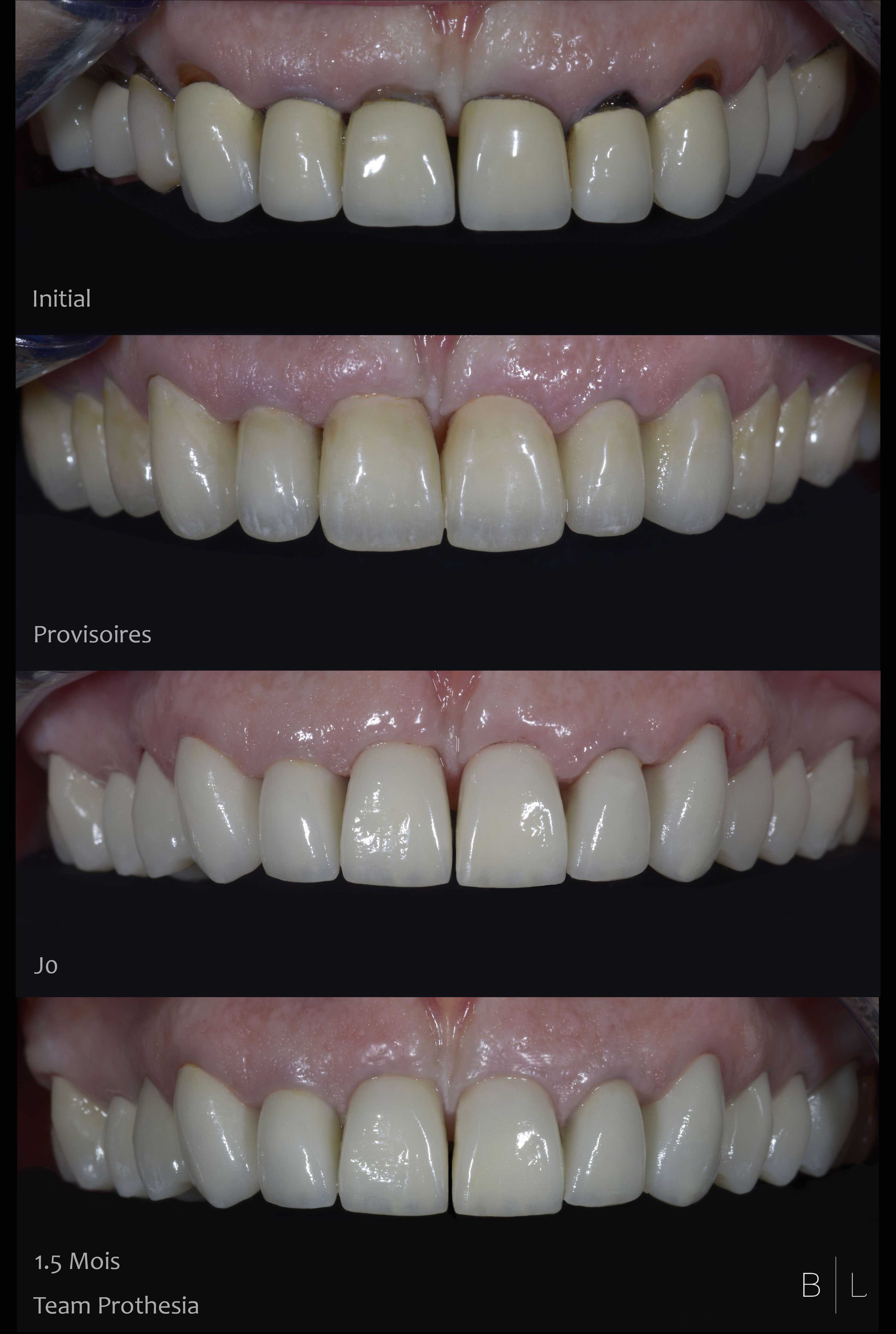 8-integration-gingivale-dentistes-antibes